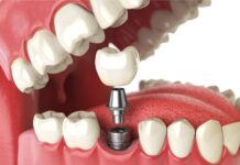 Advancement in Dental Implants Procedure