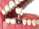 Advancement in Dental Implants Procedure